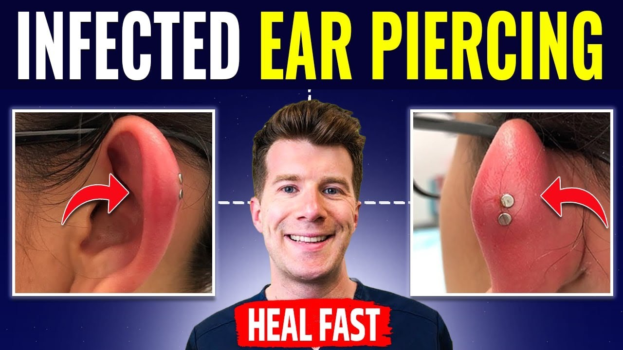 Ear Piercing Infection Causes Symptoms Pictures Bump And Treatment Nbkomputer