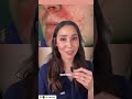 how to treat perioral dermatitis dr. mamina board certified dermatologist