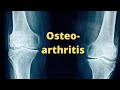 A Brief Overview of Osteoarthritis