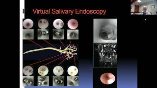 Sight + Sound Bites: Salivary Endoscopy for Salivary Stones