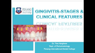 GINGIVITIS  STAGES & CLINICAL FEATURES