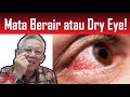 Mata Berair atau Dry Eye 👁️ Apa nak buat!?