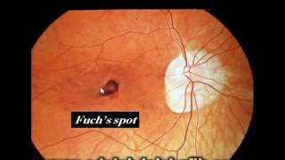 Errors of refraction for undergraduates : Myopia Errors of refraction for undergraduates : Myopia