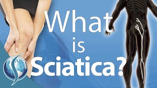 What Is Sciatica?
