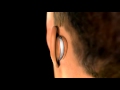 Ear Plastic Surgery - 3D Medical Animation || ABP ©