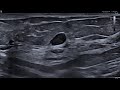 12. Breast Papillary Tumor 18L7 | Ultrasound Aplio a-series | Canon Medical Systems