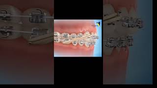 Damon Braces: How Self-Ligating Brackets Transform Orthodontics! #orthodontics#orthodontist #damon