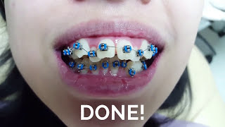 ต้องดู! จัดฟันครั้งแรก ทำอะไรบ้าง l Bangkok New Smile Dental Clinic