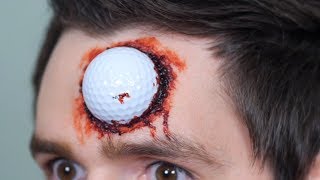 GOLF BALL LODGED IN HEAD!