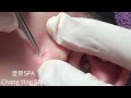 桃園中壢清粉刺  臉頰黑頭清除 Blackheads on face Removal！