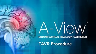 A-View® Endotracheal Balloon Catheter TAVR Procedure