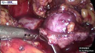 Retroperitoneal laparoscopic partial nephrectomy 後腹腔鏡部分腎切除術14分鐘一刀未剪