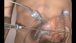 Colorectal cancer laparoscopic surgery - 3d animation