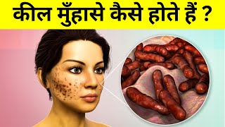 कील मुंहासे क्यों होते हैं - science behind pimples