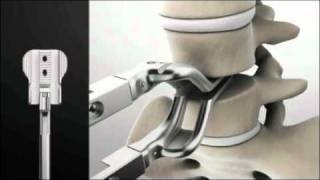 Spinal Kinetics M6-L Artificial Disc Replacement: Surgery Animation