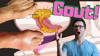 Gout ATTACK & Gout Big Toe Joint TREATMENT [Gout FOOT Treatment]
