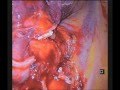 Uniportal VATS bilobectomy and superior lower lobe segmentectomy