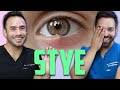 How to Treat a Stye like a Dermatologist | Doctorly Explains