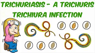 Trichuriasis - A Trichuris trichiura Infection