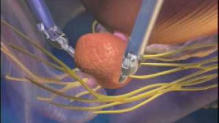 Prostatectomy_patient_video.wmv