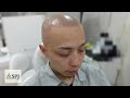 全頭脱毛症施術前後＆その後〜a whole head alopecia treatment