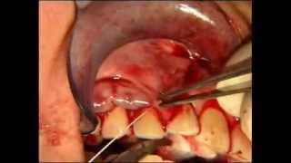 Cirugía Mucogingival en Periodoncia - Injerto Conectivo Subepitelial