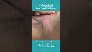 กำจัดขนรักแร้ | Long Pulse Nd YAG Laser | โดย คริสตัลคลินิก มหาสารคาม