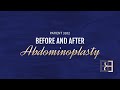 Abdominoplasty Post Weight Loss {Patient 3102} Before & After