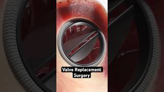 How Surgeons Replace A Heart Valve 3d Animation