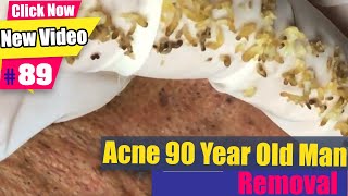Acne 90 Year old man many blackheads - Acne Treatment (#89)