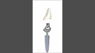 Ceramic Crown \u0026 Implant Abutment Anatomy