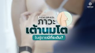 ภาวะเต้านมโตในผู้ชาย (Gynecomastia) มีกี่ระดับ