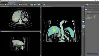 Segmentation using level set region growing