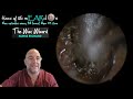 this ear blows bubbles 289 ear earwax earwaxremoval fyp earwaxclinic asmr foryou satisfying