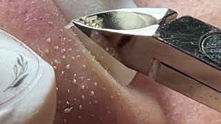 relax,Satisfying,nose blackheads,tweezers,acne treatment,鼻角栓,ピンセット,피지제거_040