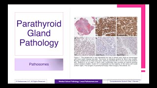 Parathyroid Gland Pathology | Comprehensive Guide \u0026 Step 1 Review | Pathology Step 1 USMLE