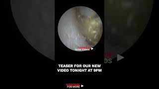 HAIRY \u0026 HARD EAR WAX PLUG REMOVAL - EP720 TEASER