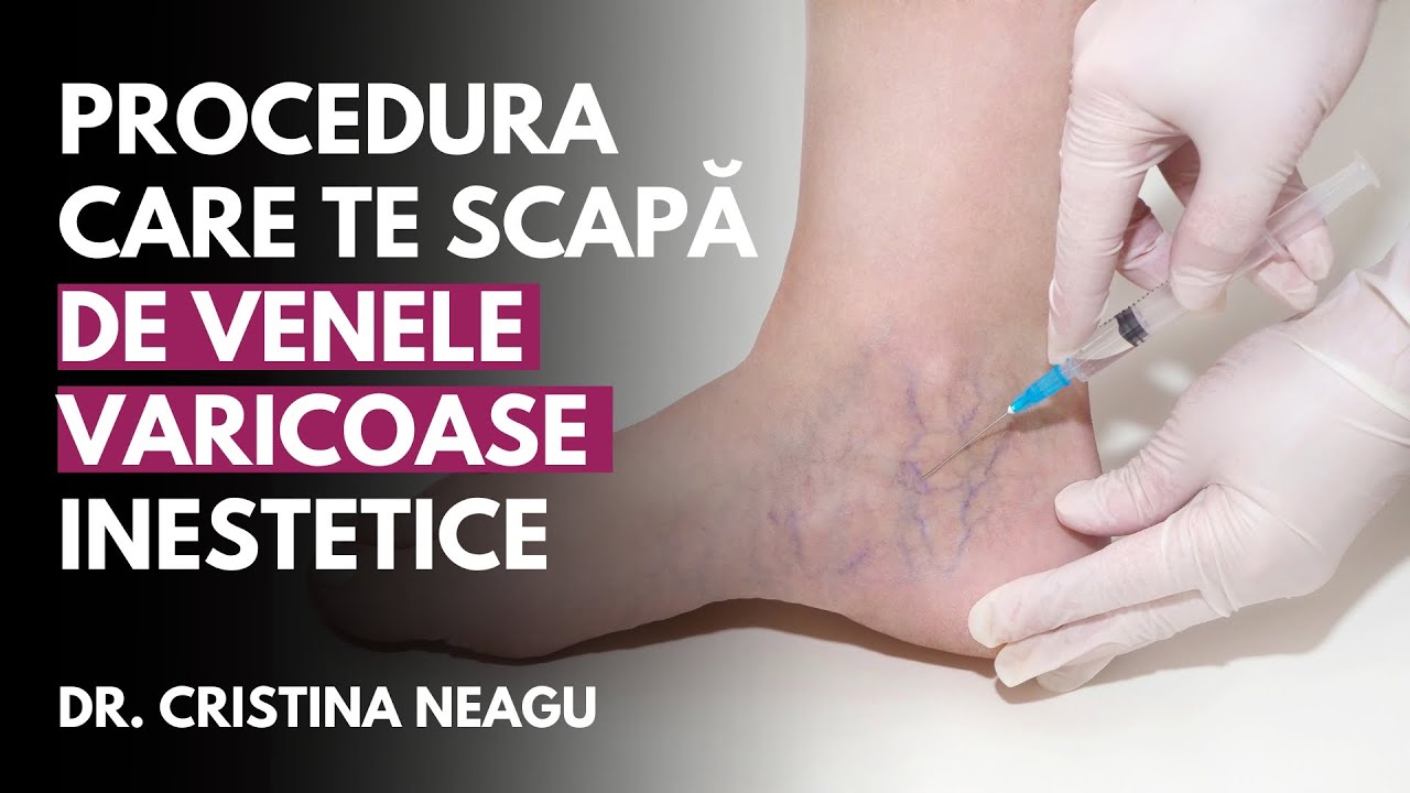 SCLEROTERAPIA – Procedura Care Te Scapă De Venele Varicoase Inestetice ...