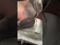 LaserTat Tattoo Removal. Timelapse of a large laser treatment.