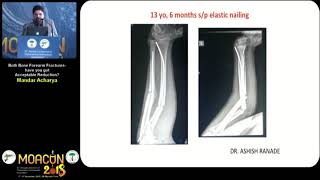 Both Bone Forearm Fractures-Have you got Acceptable Reduction?  - Dr Mandar   A charya