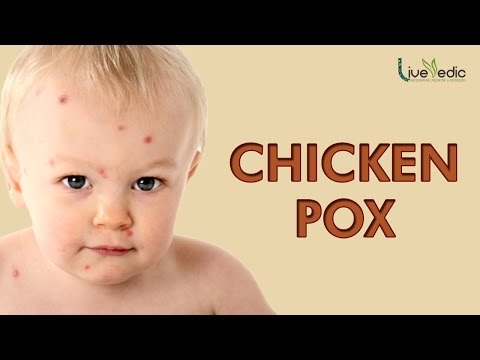DIY: Best Cure For Kids Chicken Pox with Natural Home Remedies | LIVE VEDIC DIY: Best Cure For Kids Chicken Pox with Natural Home Remedies | LIVE VEDIC