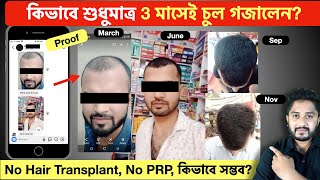 কিভাবে শুধুমাত্র 3 মাসেই চুল গজালেন? 3 Months Hair Growth Result without Transplant.