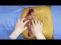 Closure of Bilateral Transverse Thoracosternotomy Using FiberTape® Sternal Closure System