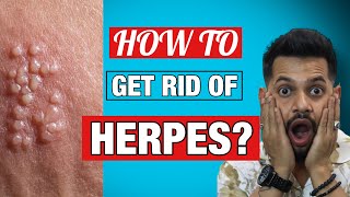 हर्पीस से छुटकारा पाने का असरदार उपाय ? | How To Get Rid Of HERPES ? | Ani Ray