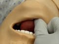 tracheal intubation direct laryngoscopy