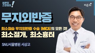 최소침습 무지외반증 수술 (MICA)의 모든 것! 최소 절개, 최소 흉터 / SNU서울병원 서상교 [서상교의 발, 발목] #4