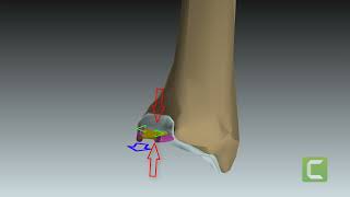 Articulacion Radiocubital Distal. Fibrocartilago triangular