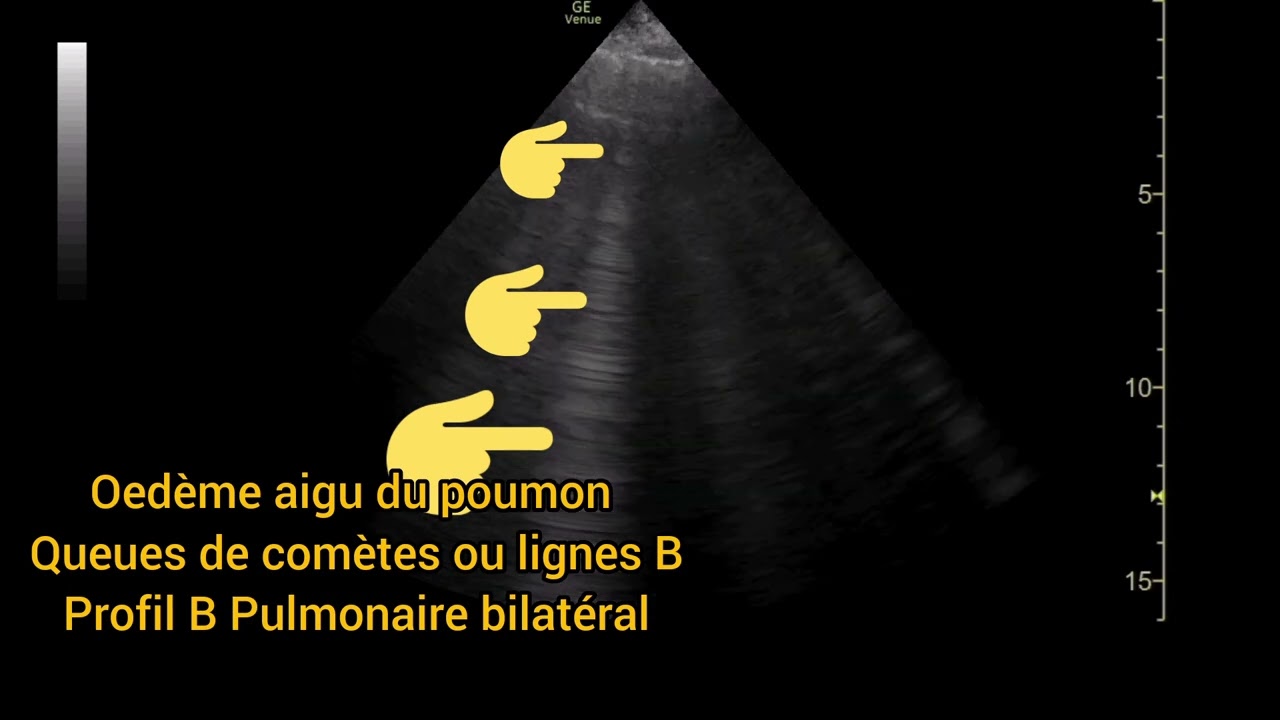 Oedème Aigu Du Poumon Syndrome Interstitiel Queues De Comètes Lignes B ...