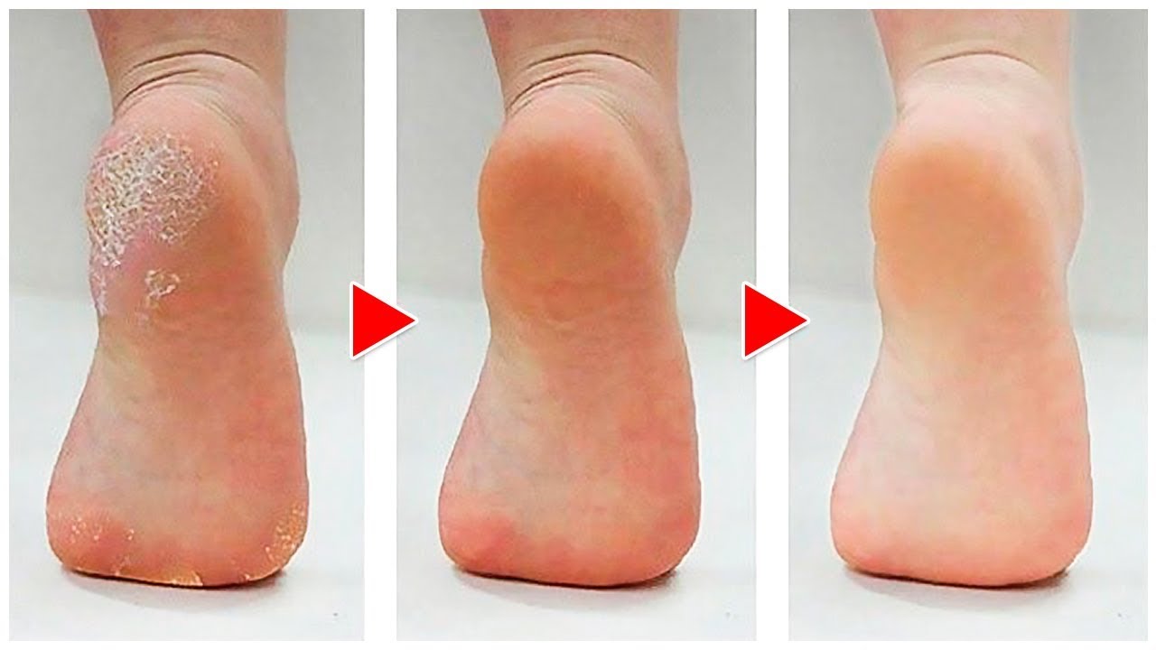 How To Get Rid Of Calluses On Feet Naturally - YouTube