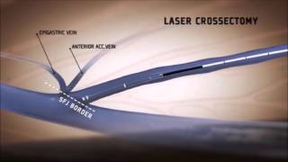 laser crossectomy dr Dragić